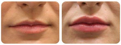 Lip Augmentation